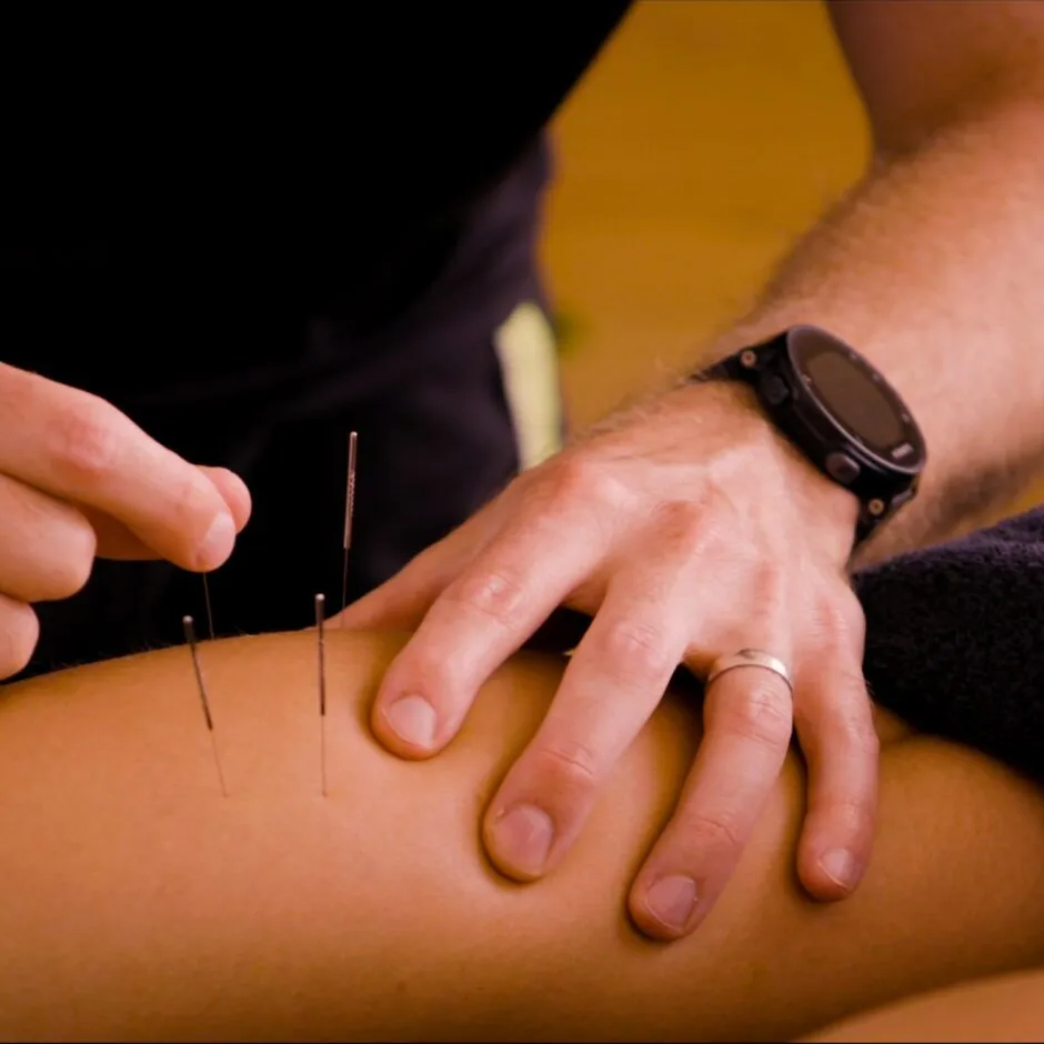 Acupuncture